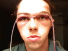 One day after Scalp Avulsion Repair